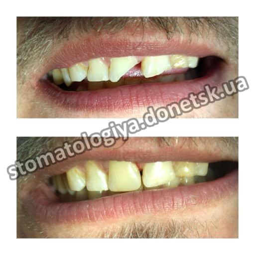 стоматолог Донецк реставрация зубов недорого